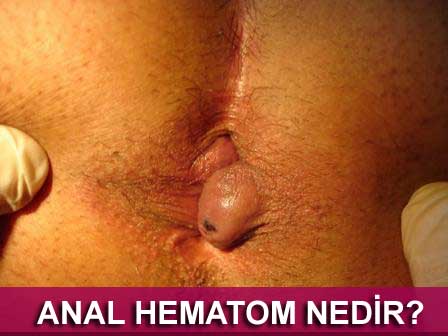 anal hematom nasıl geçer