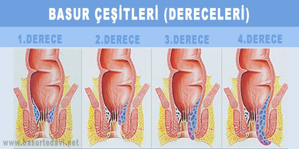 basur çeşitleri