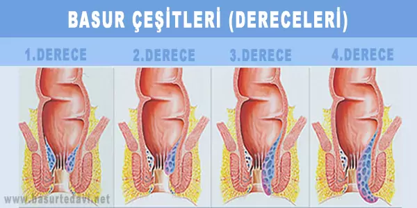 basur çeşitleri nelerdir