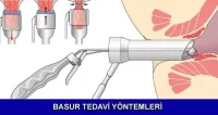 basur tedavi yöntemleri nelerdir