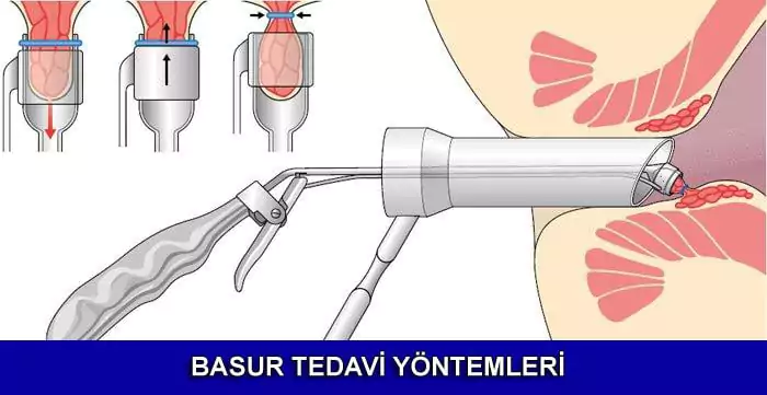 basur tedavi yöntemleri nelerdir