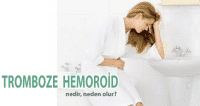 tromboze hemoroid